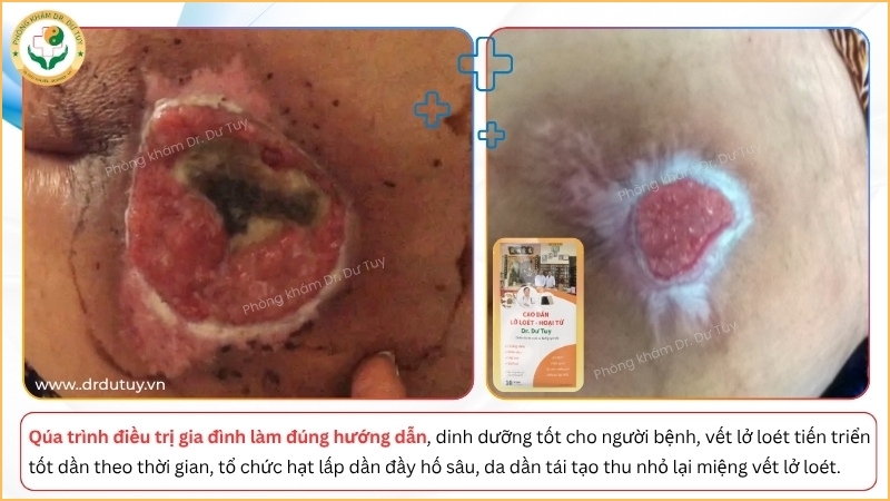 qua-trinh-vet-loet-thu-nho-va-len-da-non (1)
